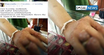 อุทาหรณ์ ชายสติไม่ดีสวมแหวนจนรัด ไม่ยอมไปหาหมอ บวมเป่งนิ้วเกือบขาด